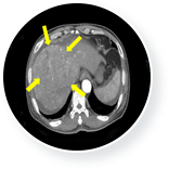 간암 치료 전 이미지