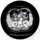 췌장암 치료 후  이미지