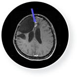 뇌종양 치료 후  이미지